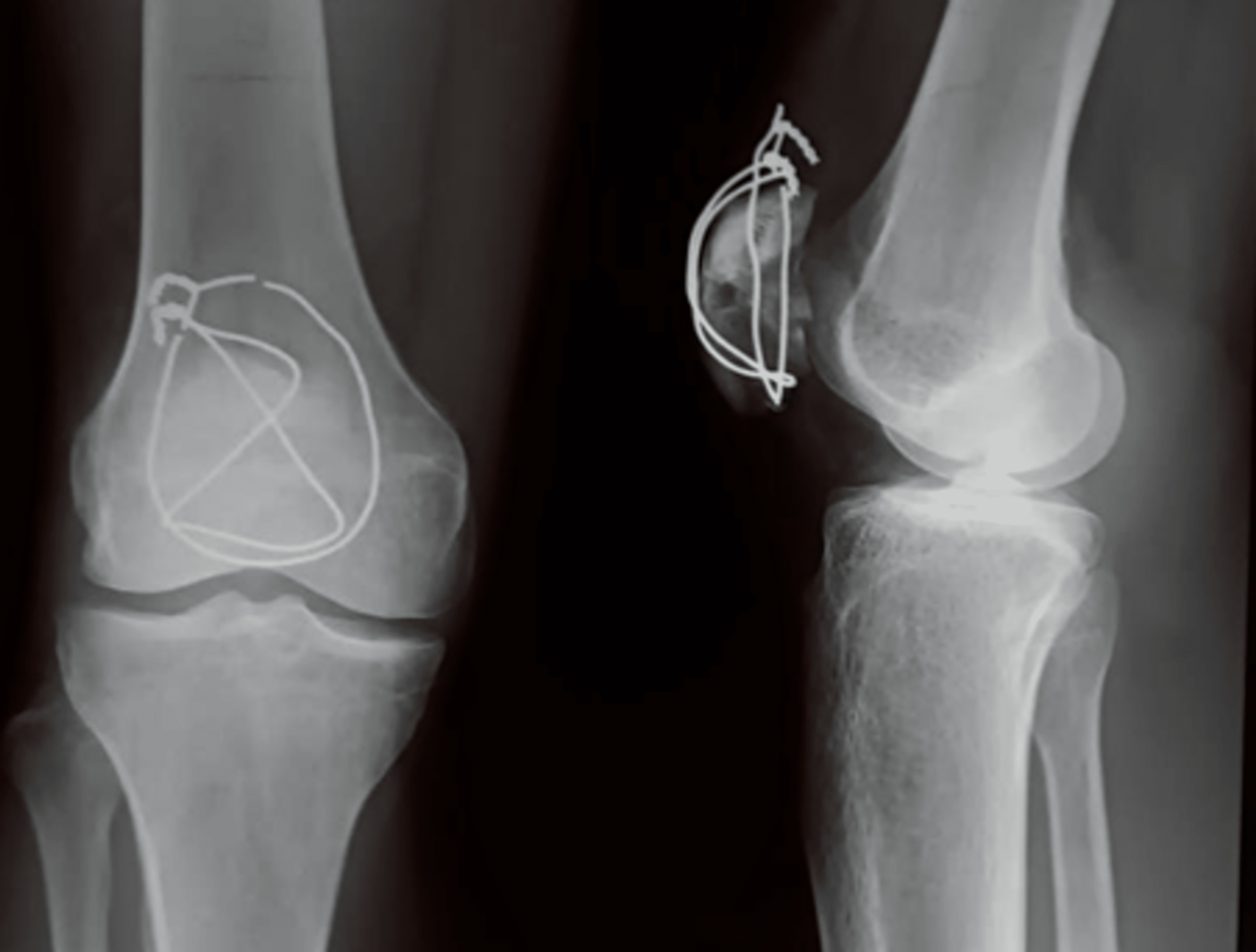 Cureus Achieving Rapid Healing and Low Complication Rates in Patellar