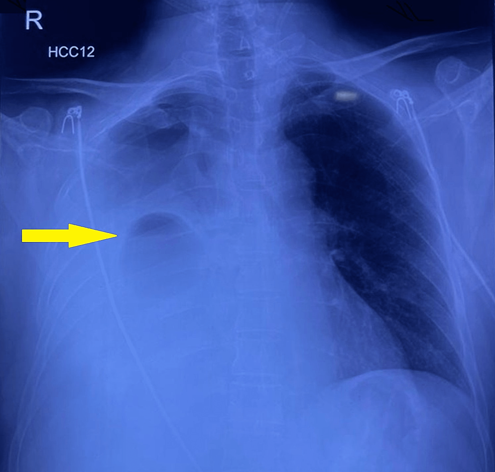 Cureus | Hydropneumothorax: A Presentation Of Infected Bronchogenic Cyst