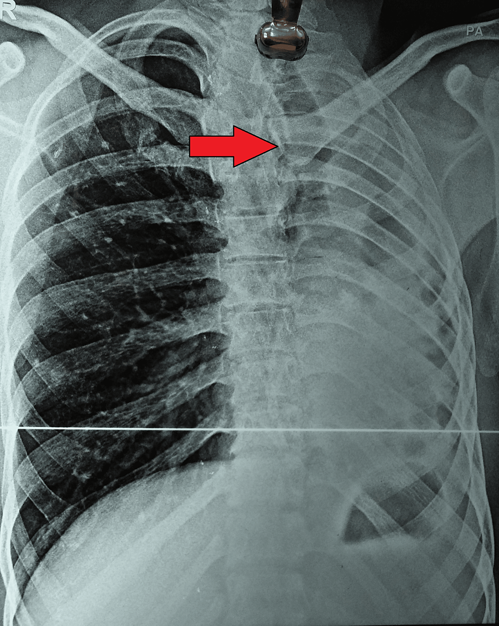 Cureus | Destroyed Lung Syndrome in a Young Indian Male: A Case Report