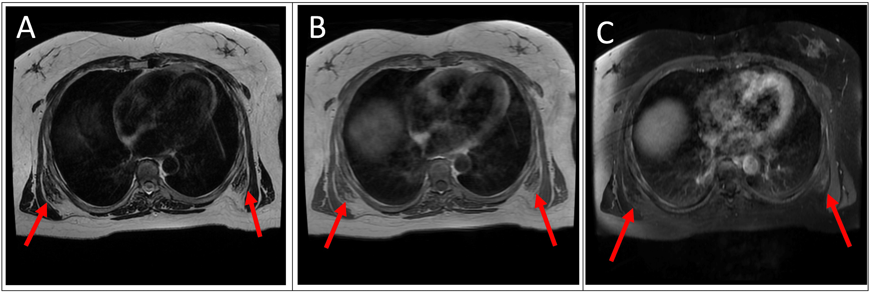 The First Reported Presentation Of Quadruple Locations Of Elastofibroma