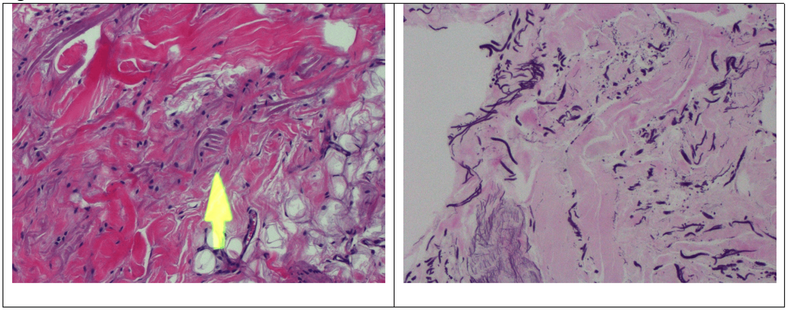 The First Reported Presentation Of Quadruple Locations Of Elastofibroma