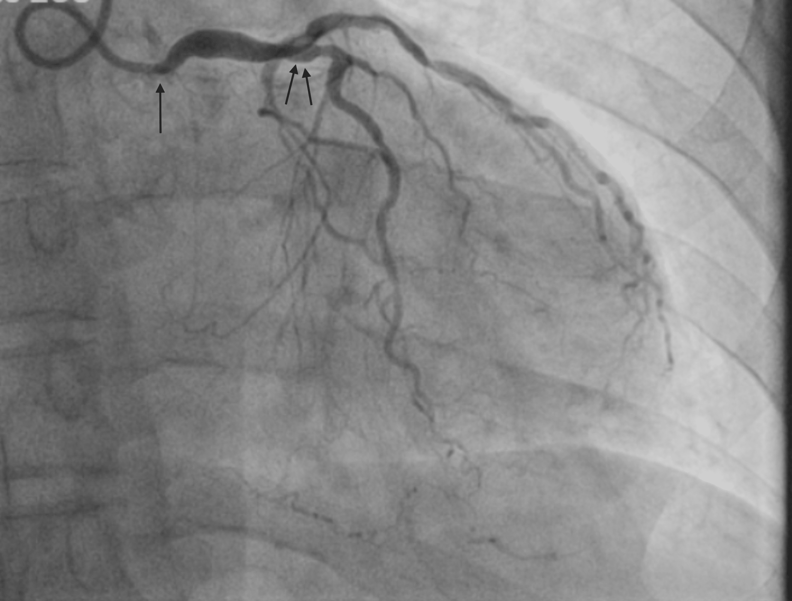 Cureus An Unusual Case of Severe Aortic Stenosis and TripleVessel