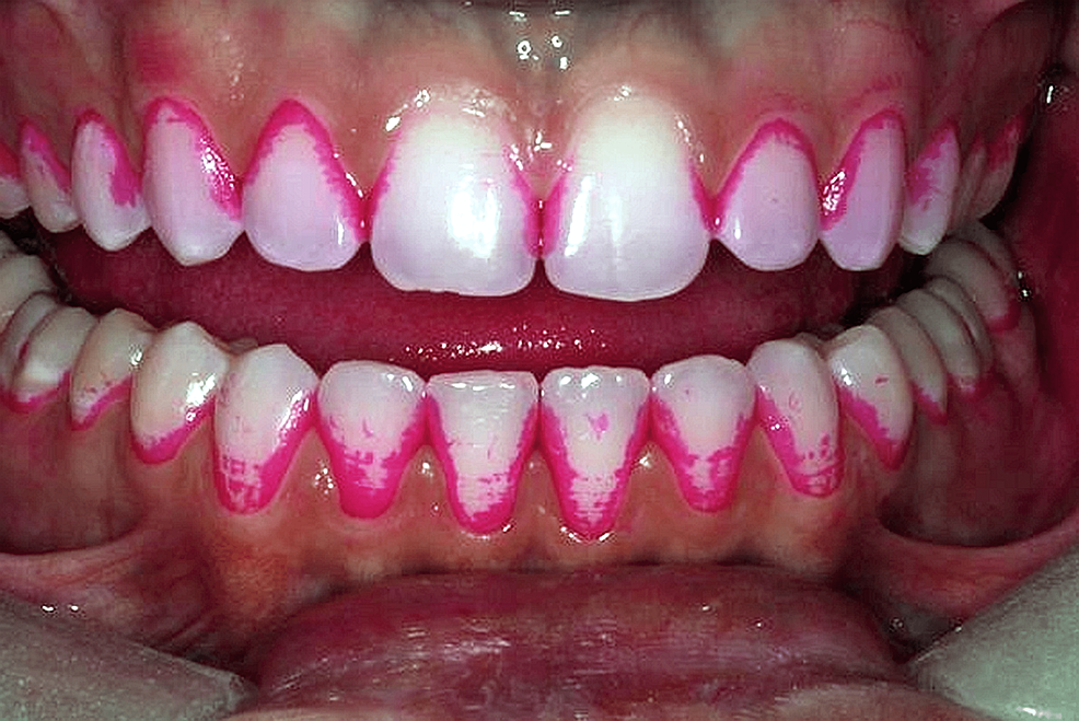 Cureus The Efficacy of the Three Types of Plaque Control Methods