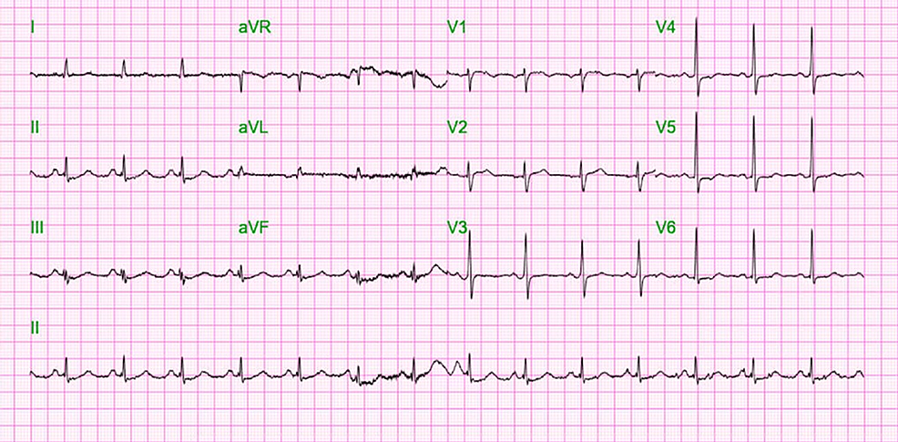 Cardiac Arrest (CA) as the Initial Presentation of Cocaine-Induced ...