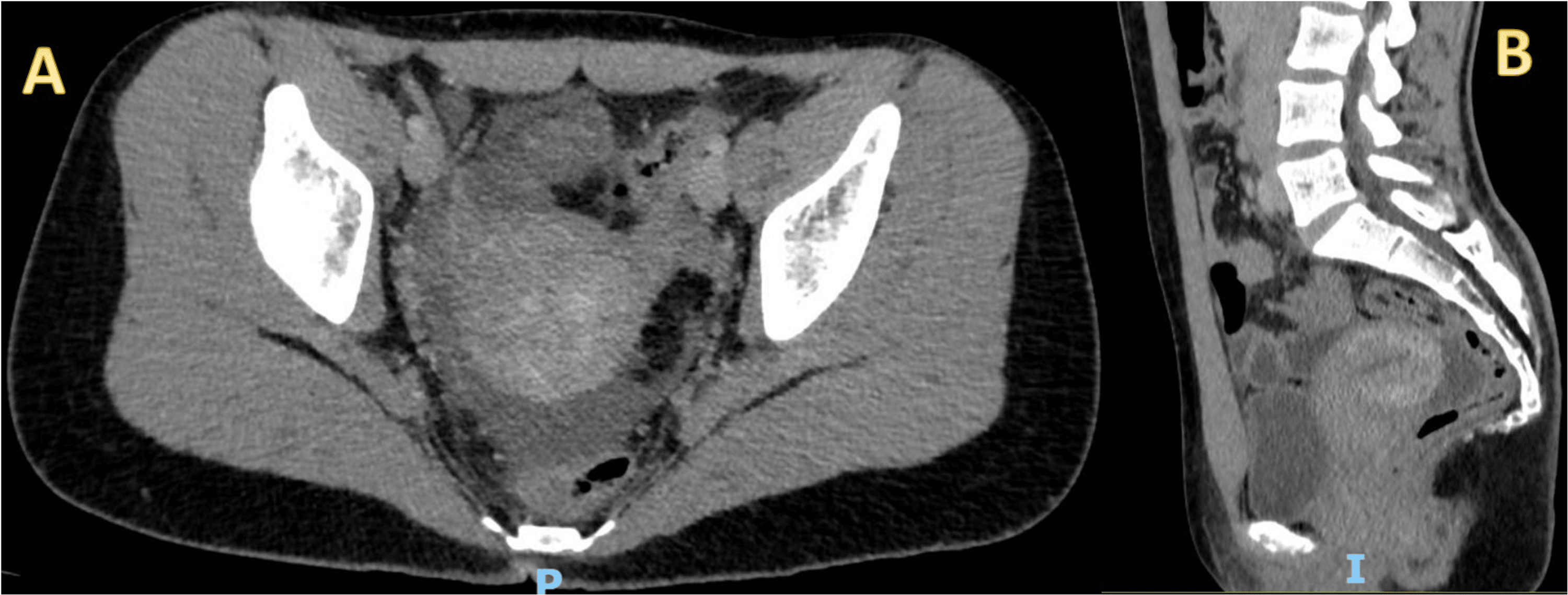 Rectouterine Pouch (pouch Of Douglas