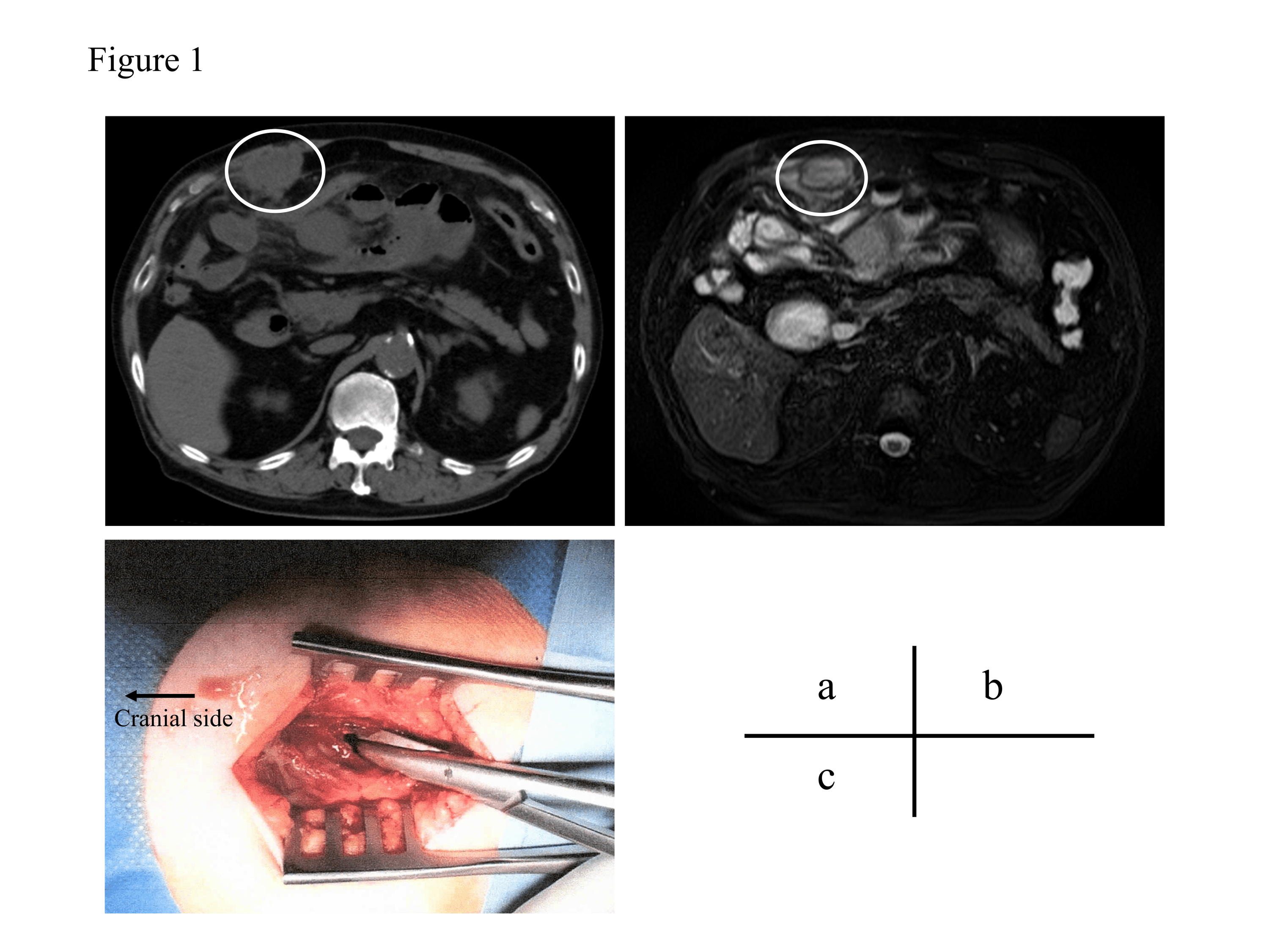 Cureus | Recurrent Primary Abdominal Wall Abscess: A Case Report and ...