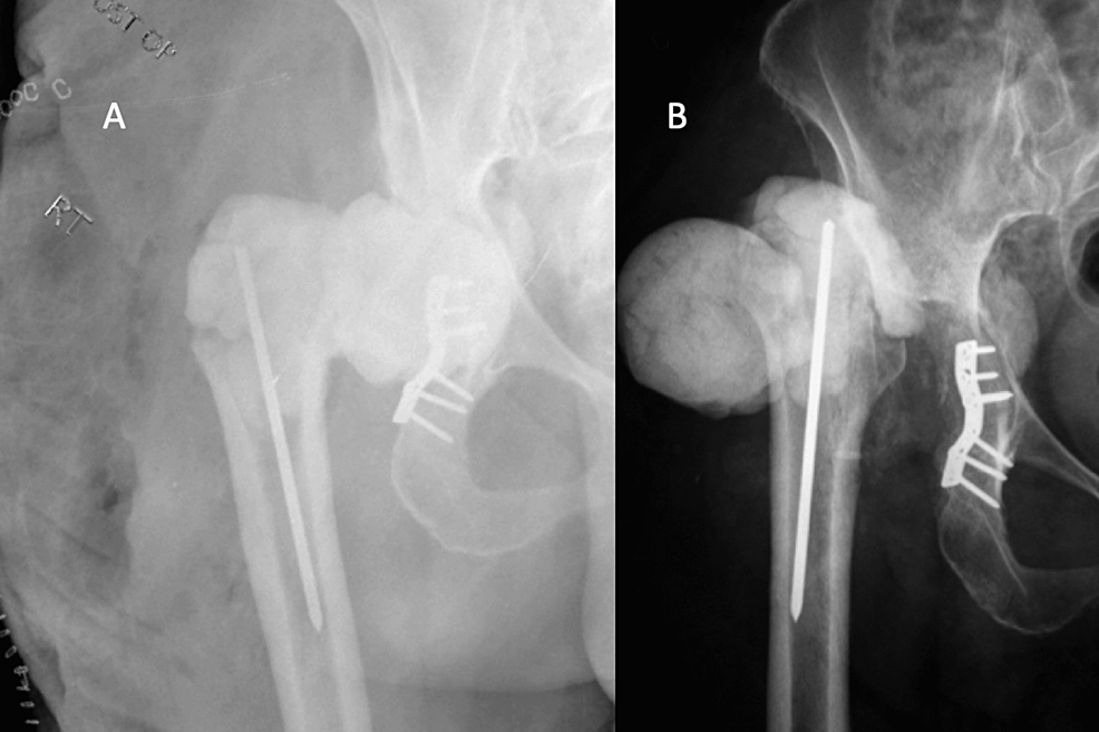 Cureus Mechanical Complications of Hip and Knee Spacers Are Common