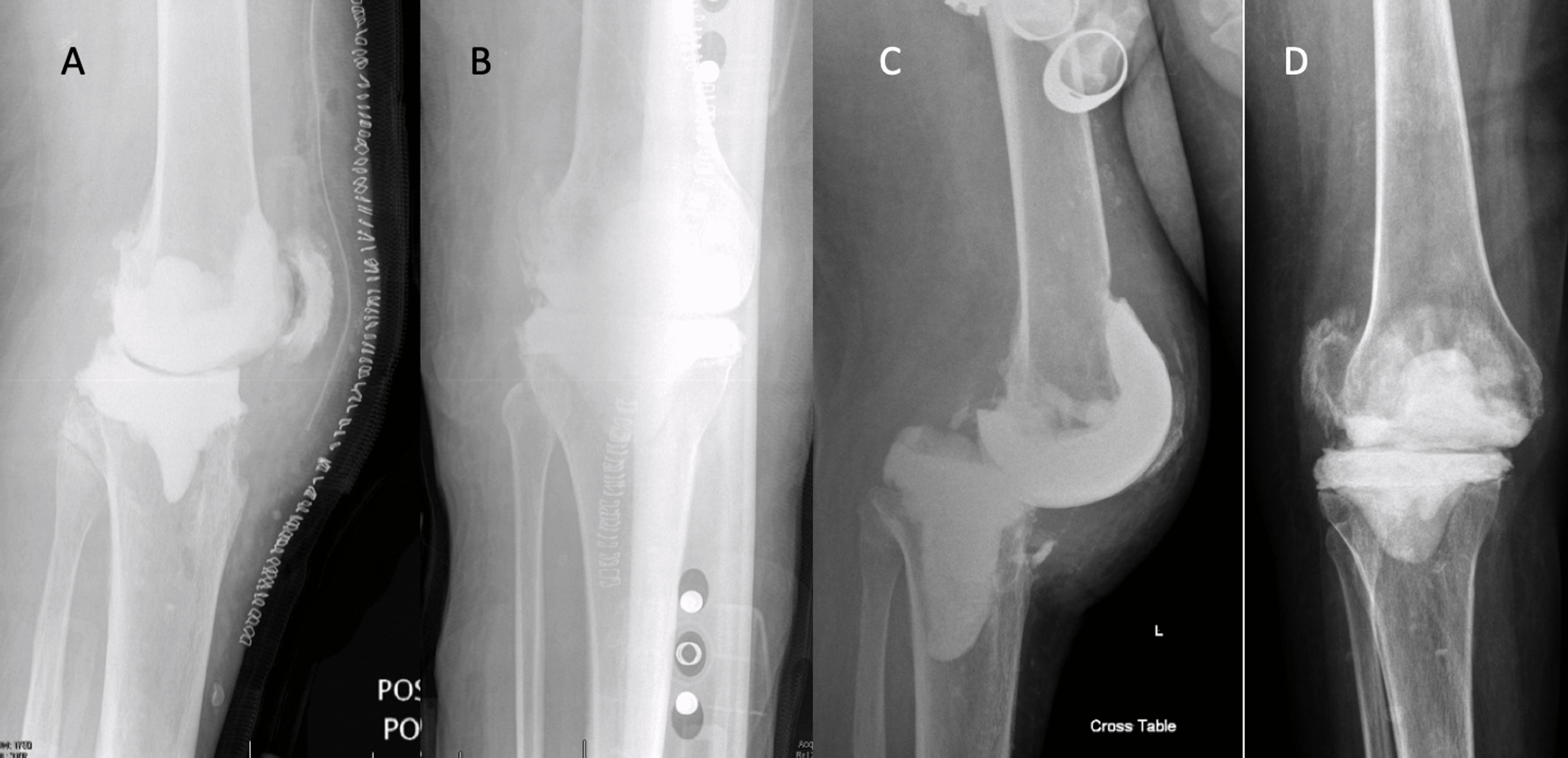 Mechanical Complications of Hip and Knee Spacers Are Common Cureus