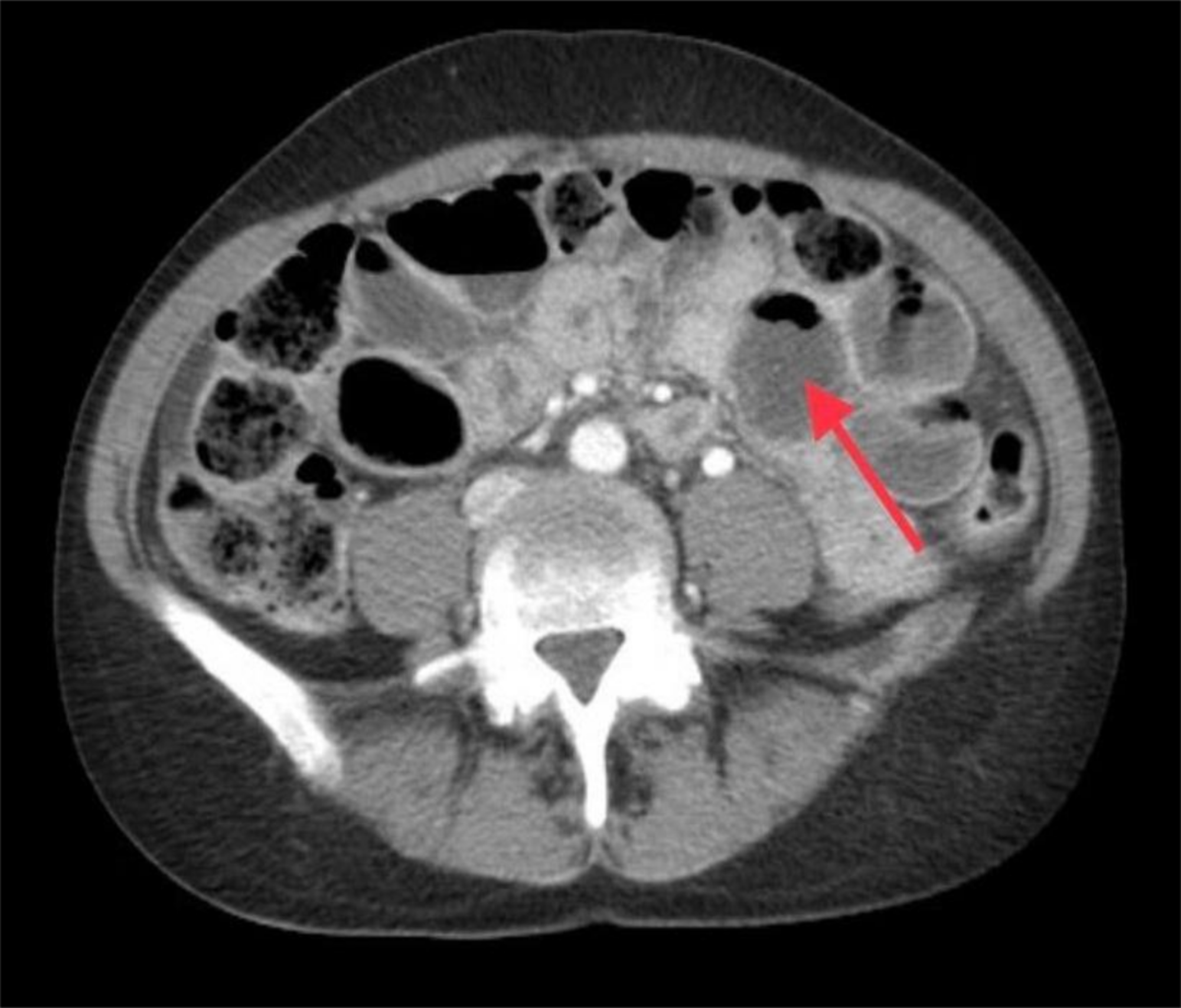 Bowel Obstruction On CT Scan