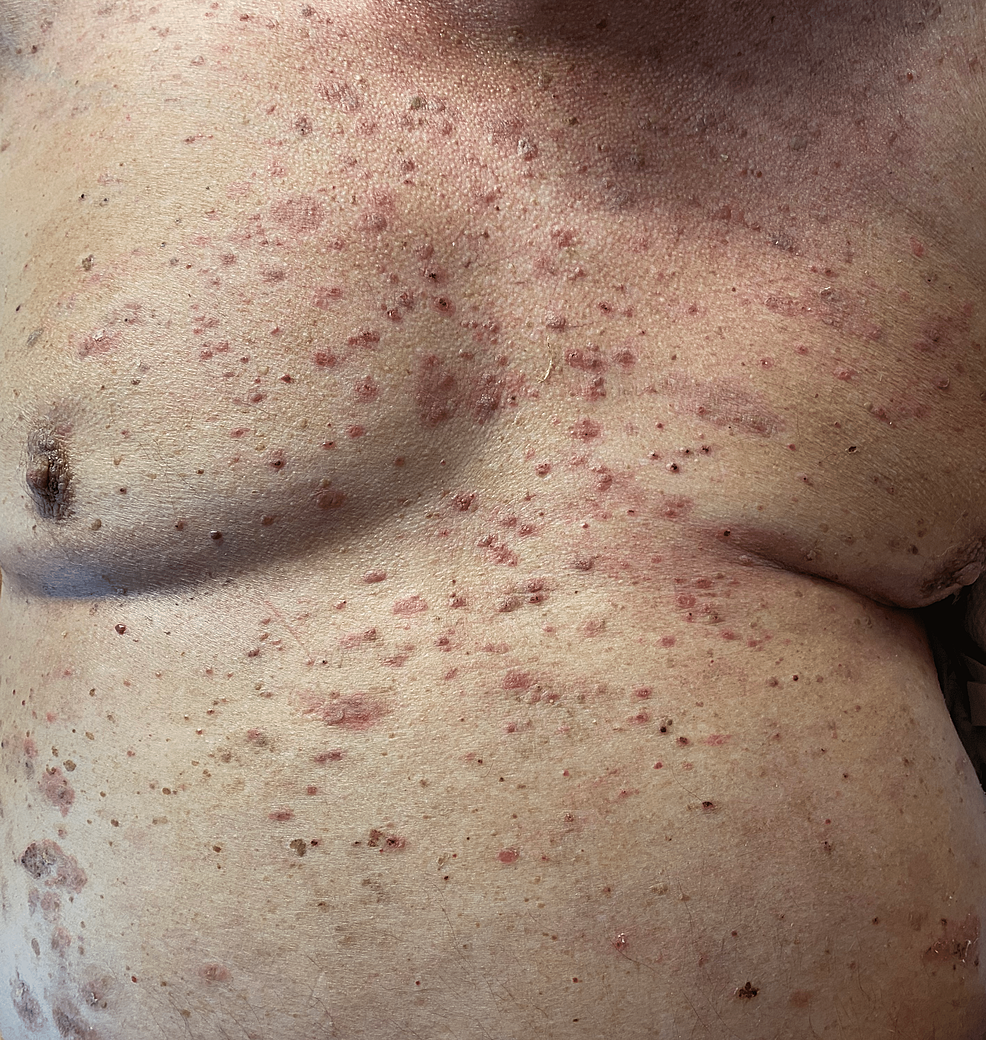 Cureus An Unusual Trigger of Grover’s Disease (GD)