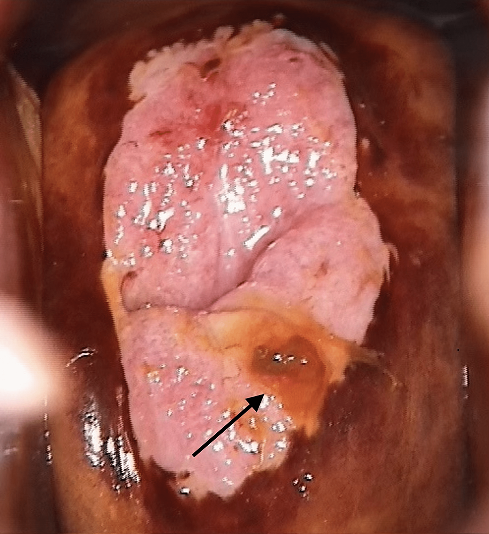 cureus-cervical-intraepithelial-neoplasia-grade-3-in-the-third