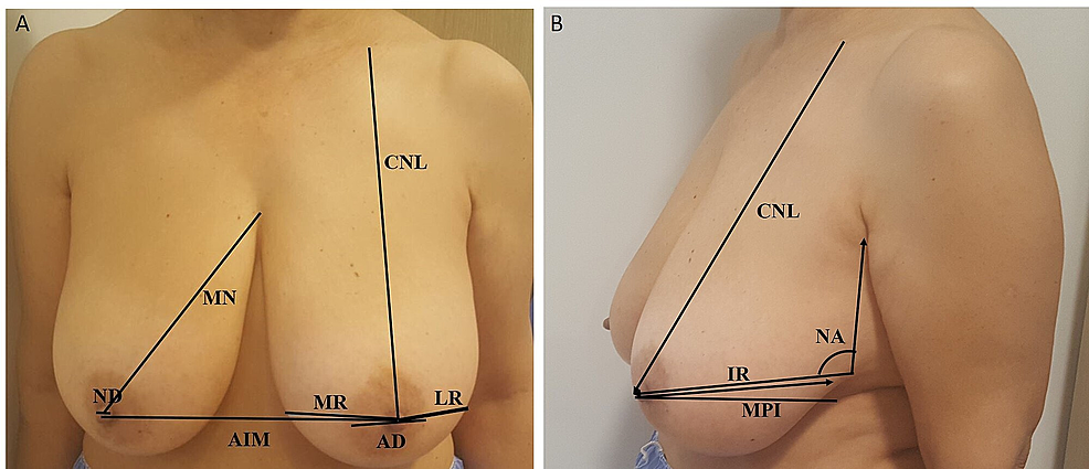 Hypertrophic breasts versus normal-sized breasts: Comparison of