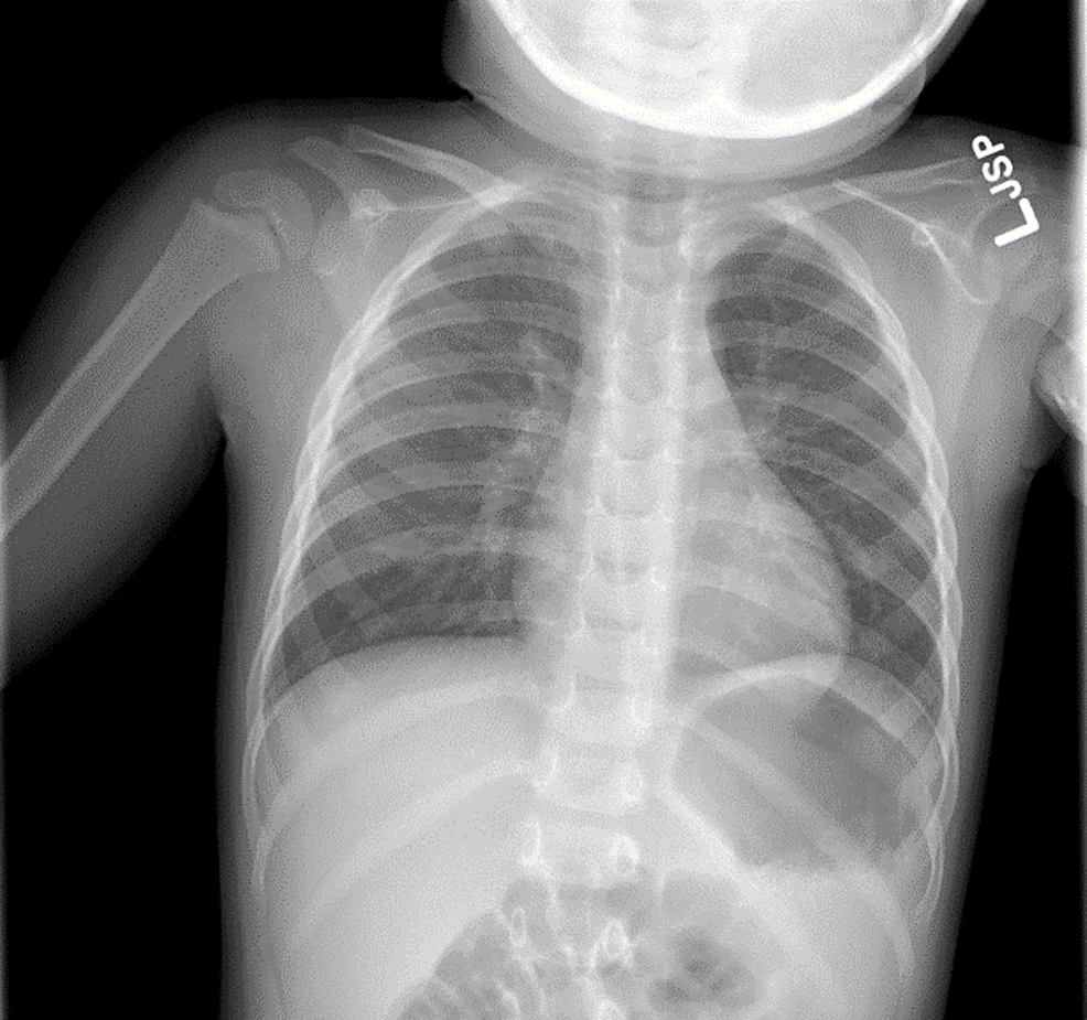 Hemoptysis In Pediatric Patients Cureus