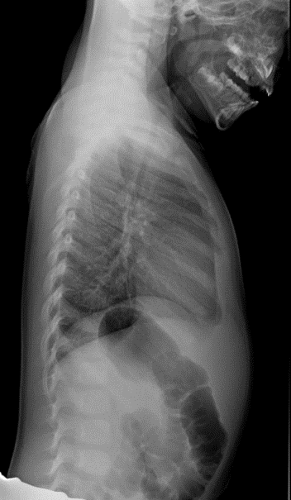 Cureus Hemoptysis In Pediatric Patients