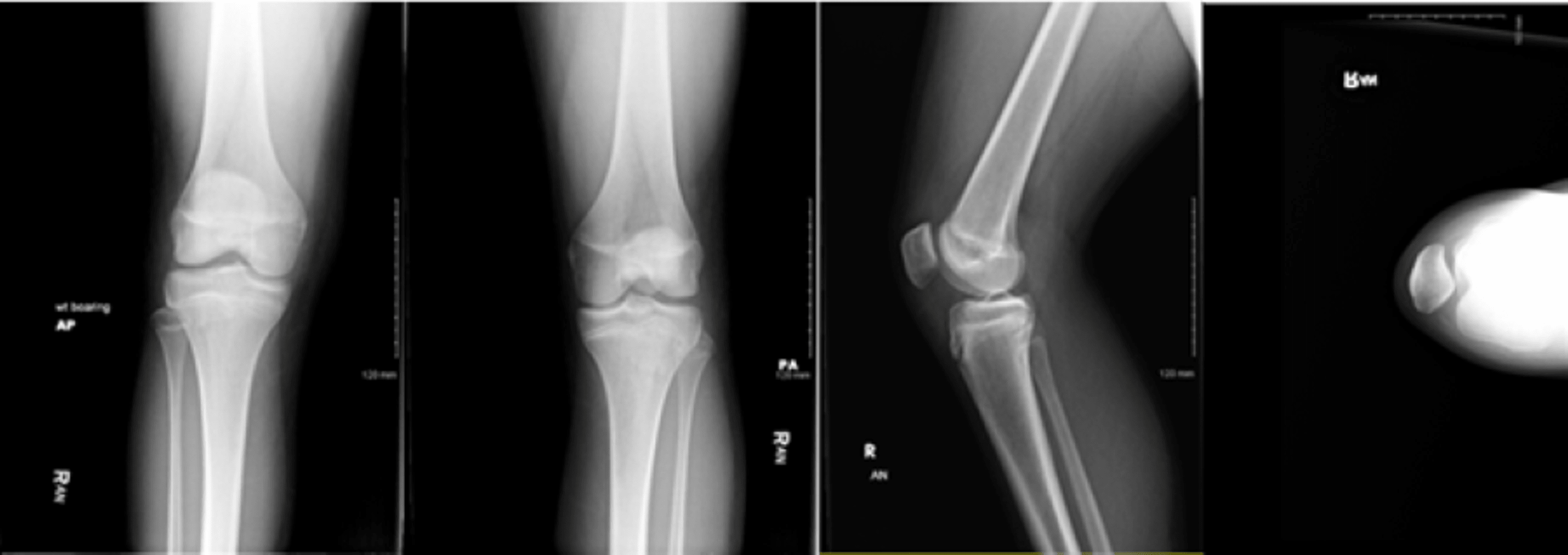 Cureus Diagnosis and Treatment of a MorelLavallée Lesion in the
