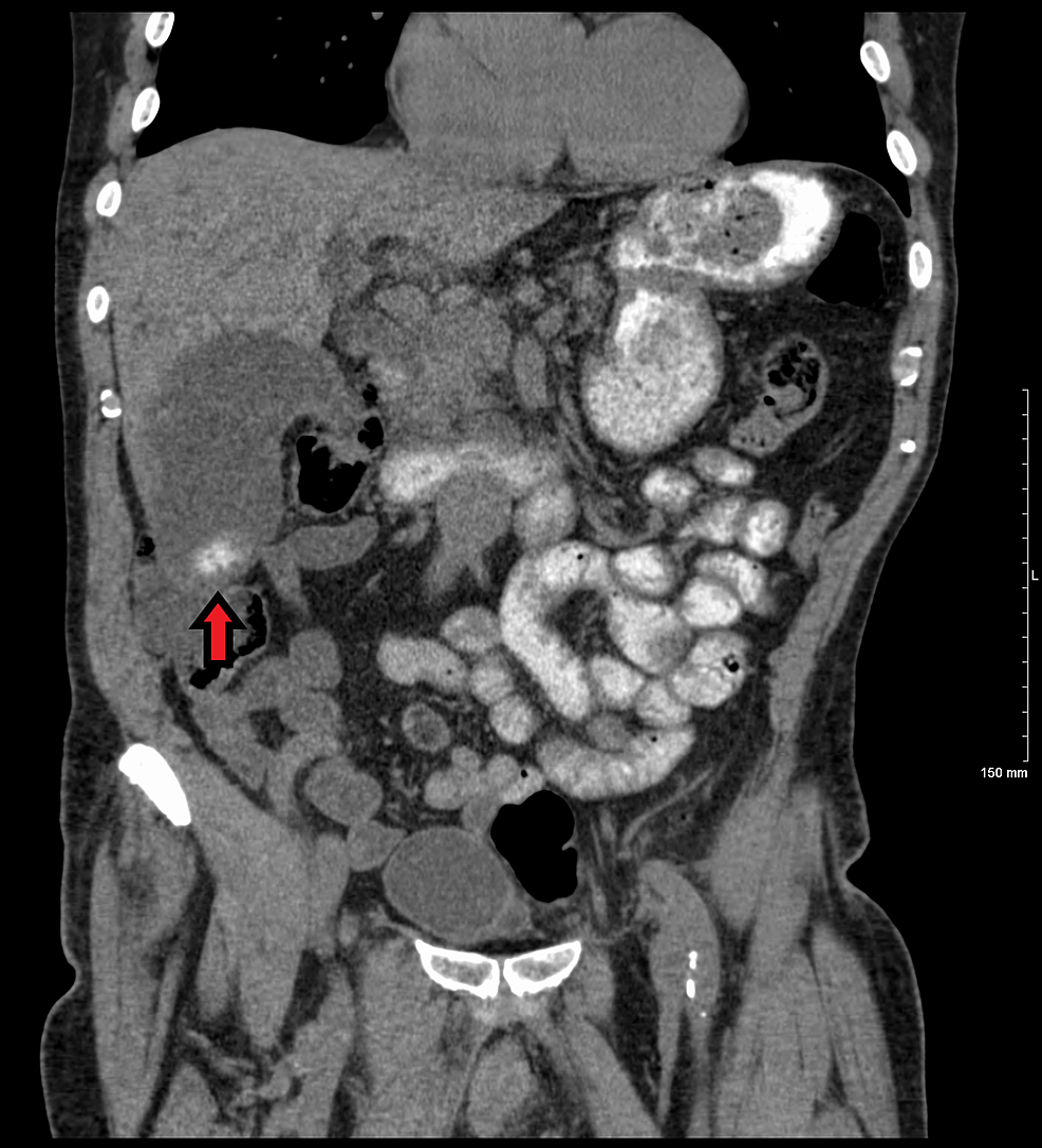 Gallbladder On Ct Scan