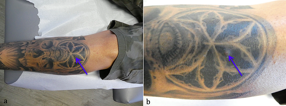 Erythematous Plaques on a Tattoo  MDedge Dermatology