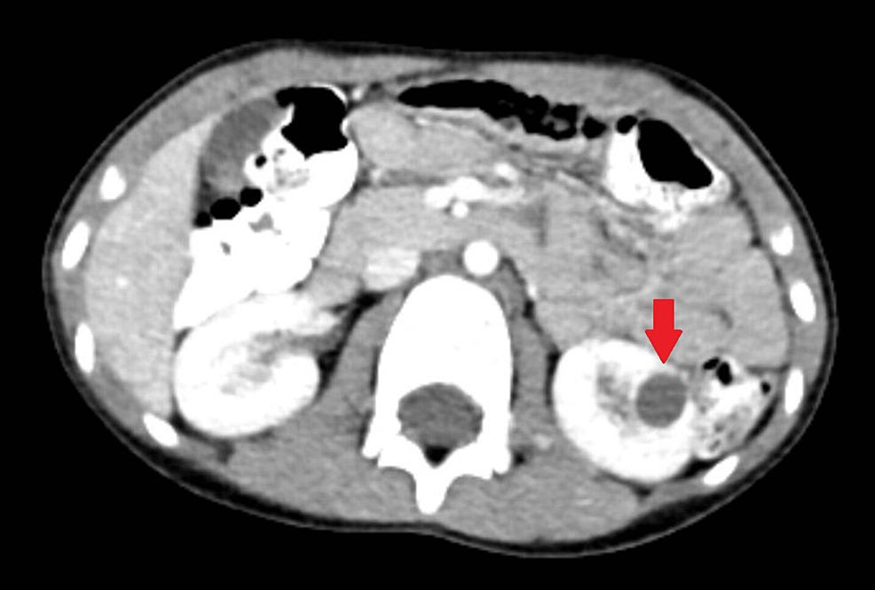 a-rare-isolated-kidney-cyst-hydatid-cyst-cureus