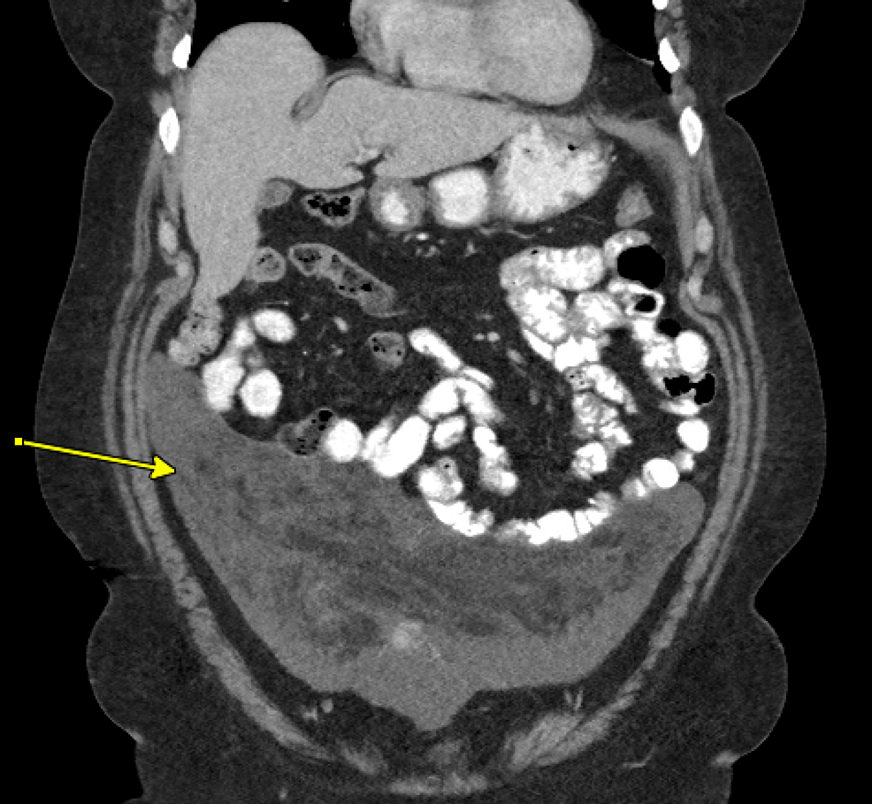 recurrent-large-extrauterine-lipoleiomyoma-in-a-postmenopausal-woman-a