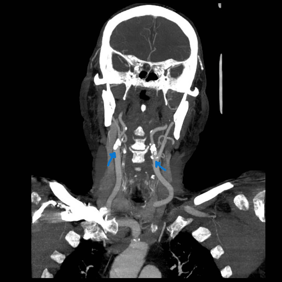 Cureus | Treating Post-stroke Epilepsy in a Patient With Multiple ...