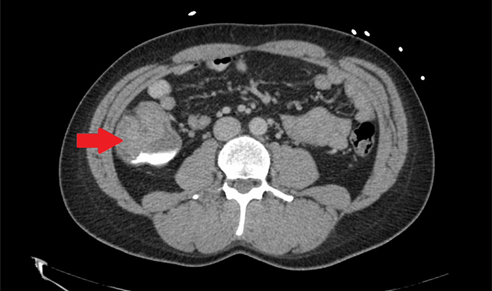 symptoms-of-colon-cancer-who-is-at-risk-from-colon-cancer