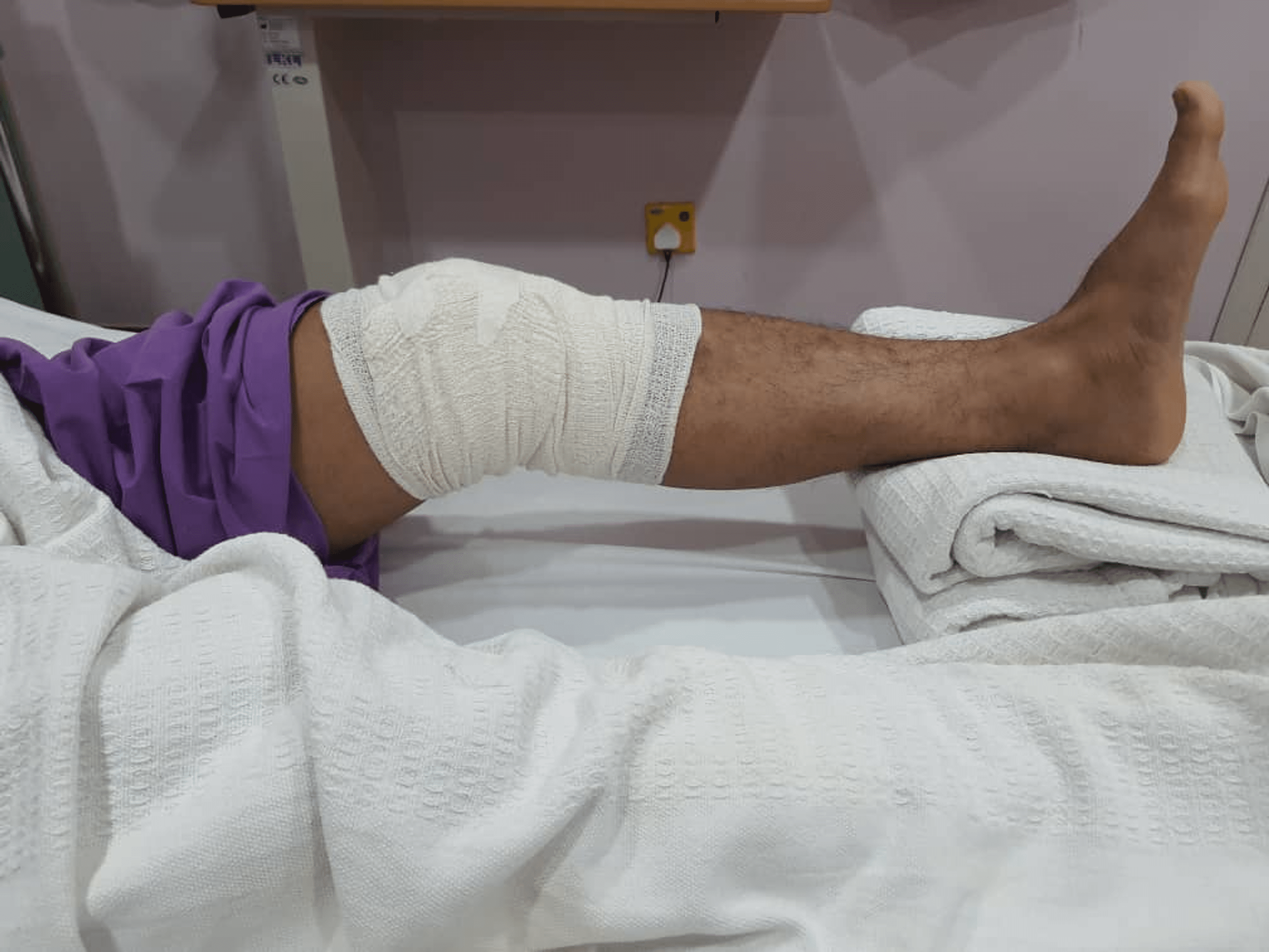 Popliteus Tendon Injury A Rare Cause of Acute Locked Knee Cureus