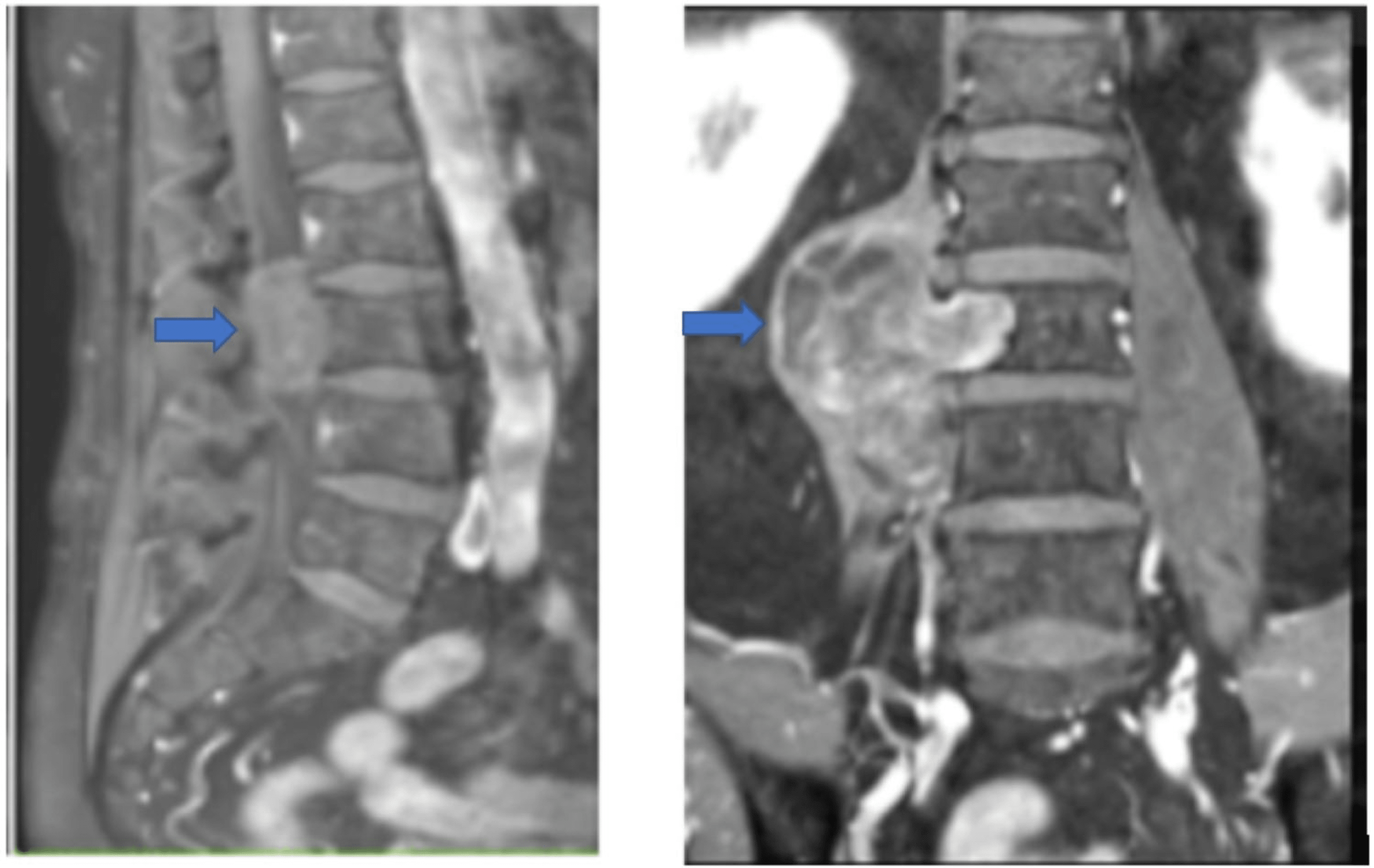 Giant Invasive Intradural Extramedullary Lumbar Schwannoma A Case