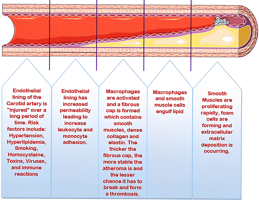 Cureus | Carotid Artery Stenosis: A Look Into the Diagnostic and ...