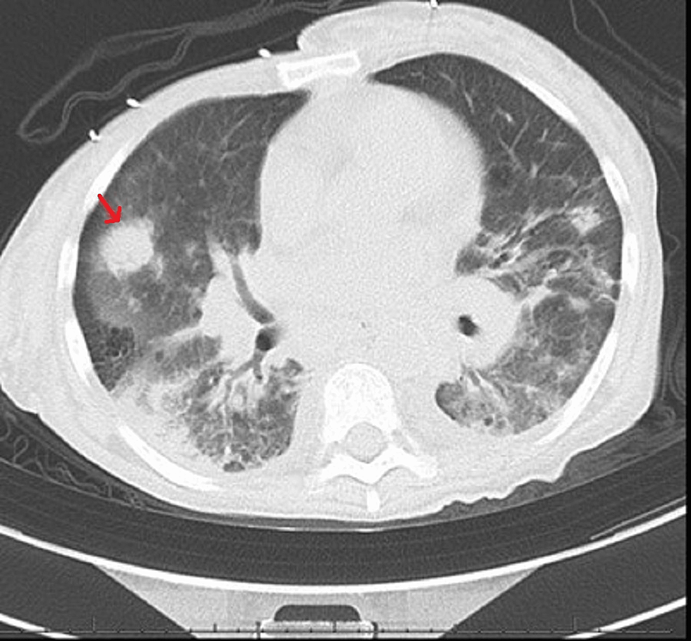 Unveiling Of Type B Lactic Acidosis From Systemic Lupus Erythematosus ...