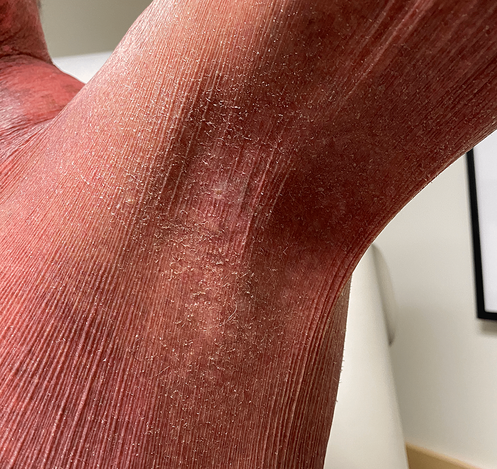 Kaposi’s Varicelliform Eruption After Treatment With Ixekizumab in a Patient With Pityriasis