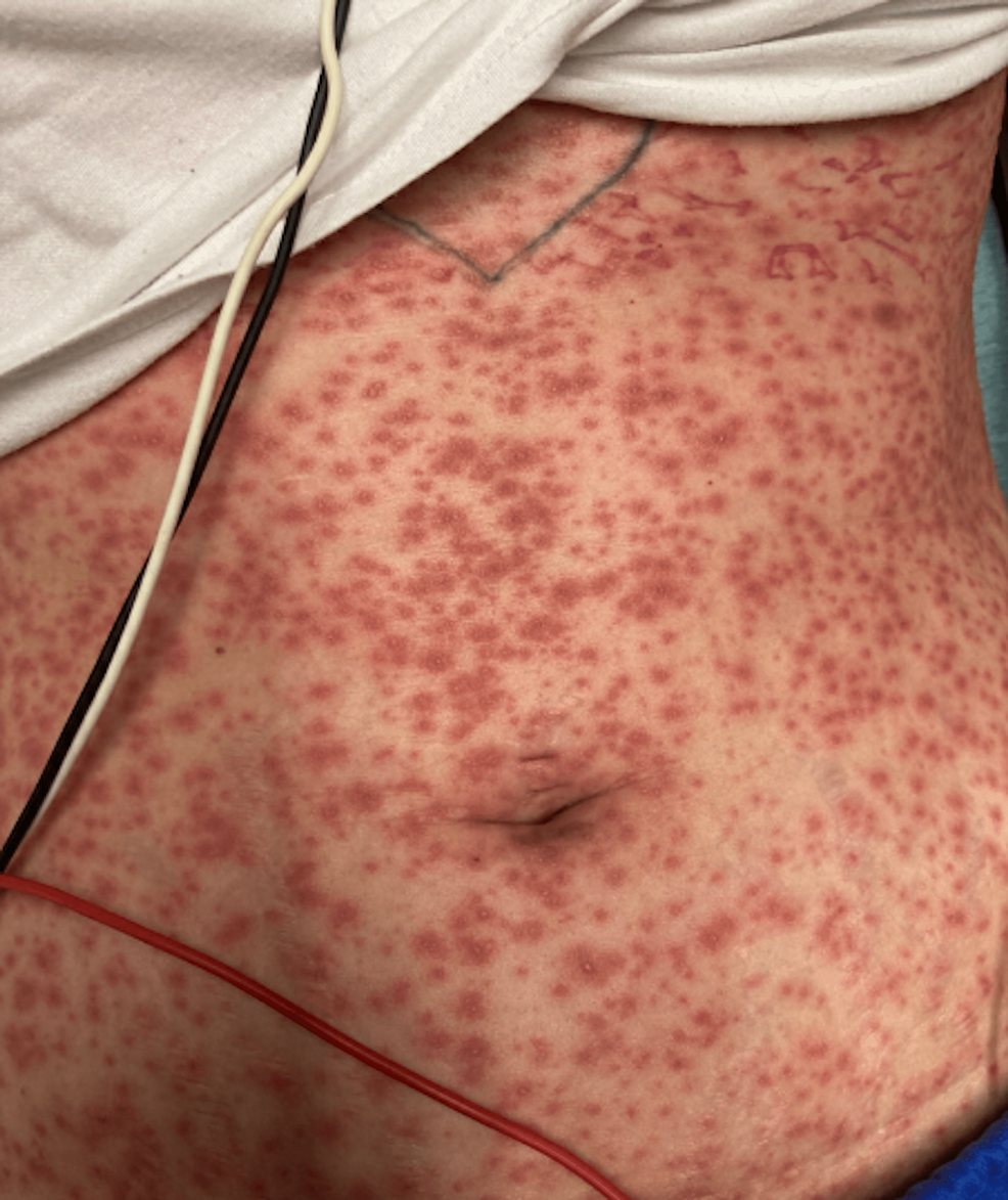 Pustules on the back possibly triggering toxic-shock syndrome
