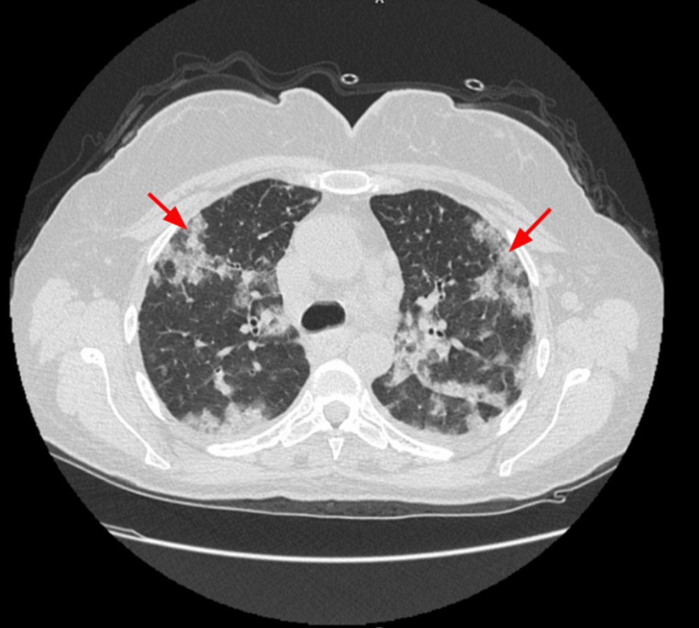 Diffuse Alveolar Hemorrhage in an Undiagnosed Systemic Lupus ...