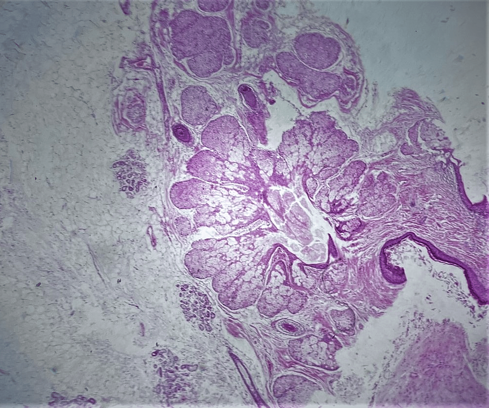 Cureus Adnexal Torsion Of A Mature Cystic Ovarian Teratoma With Hemorrhagic Infarction 9566