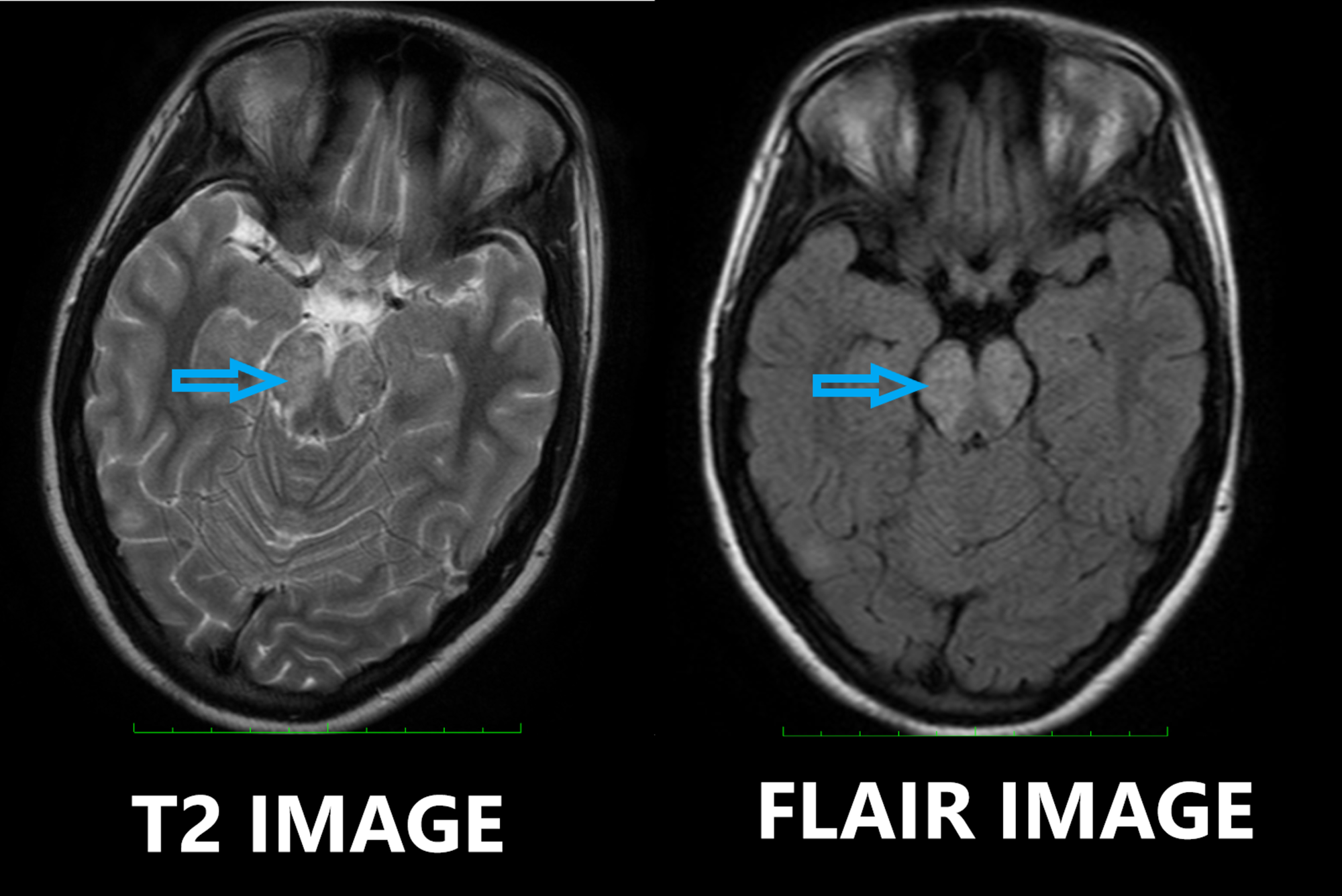 Cureus Chronic Lymphocytic Inflammation With Pontine Perivascular Enhancement Responsive To Steroids Clippers A Rare Treatable Neuroradiological Spectrum