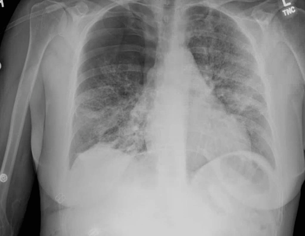 Fat Pulmonary Embolism With Crazy-Paving Pattern Opacities and ...