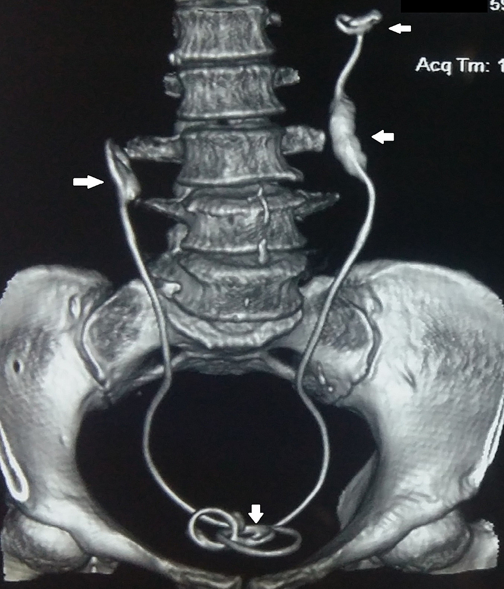 Cureus Single Session Endoscopic Removal of Bilateral Ureteric Stents