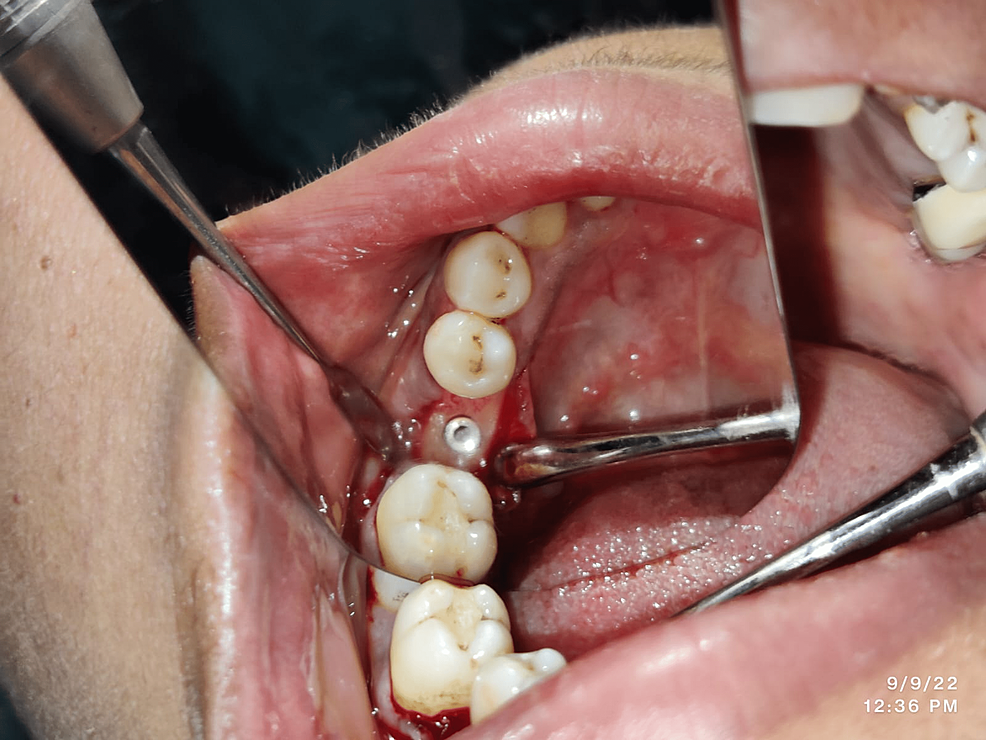 Comparative Assessment of Crestal Bone Loss by Flapless and Flap