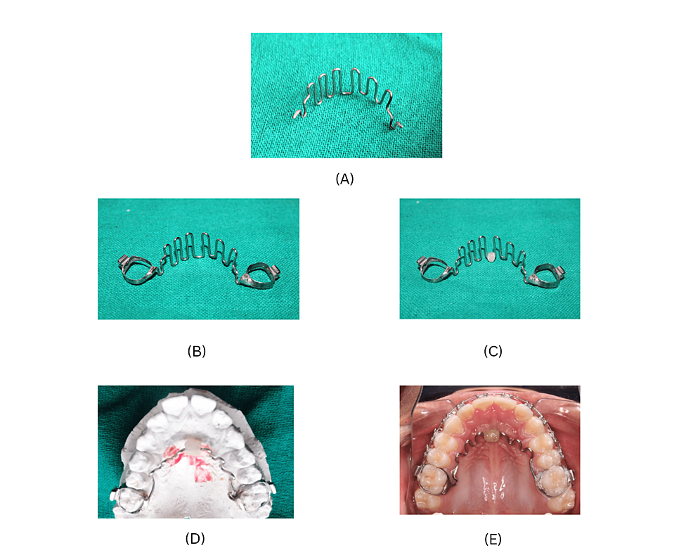 A Modified Tongue Crib Appliance for Correction of Tongue Thrusting