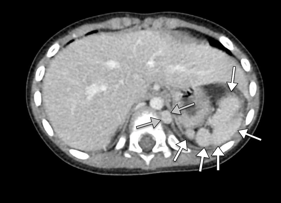 Polysplenia Syndrome Complicated By Splenic Infarction: A Report Of A ...