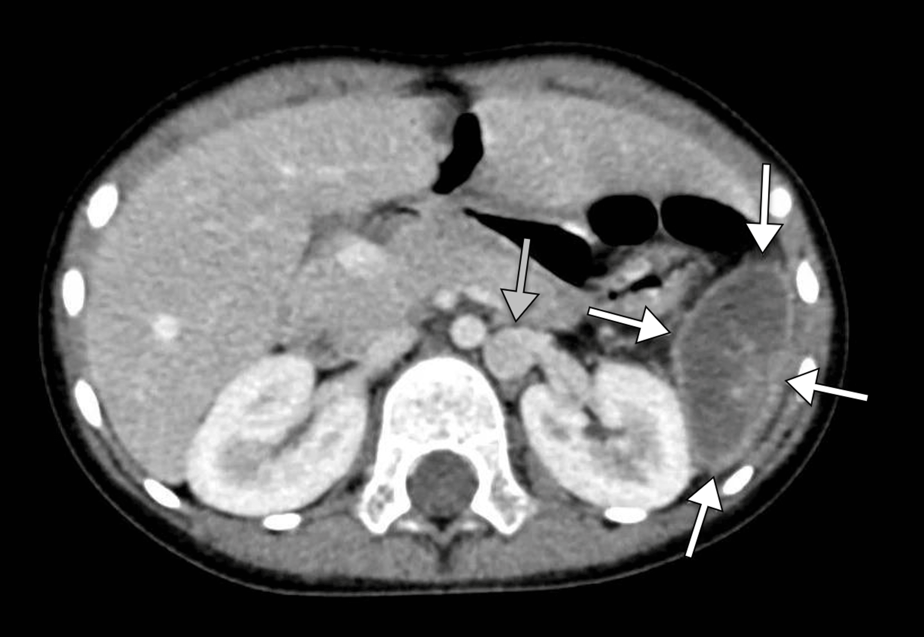 Polysplenia Syndrome Complicated By Splenic Infarction: A Report Of A ...