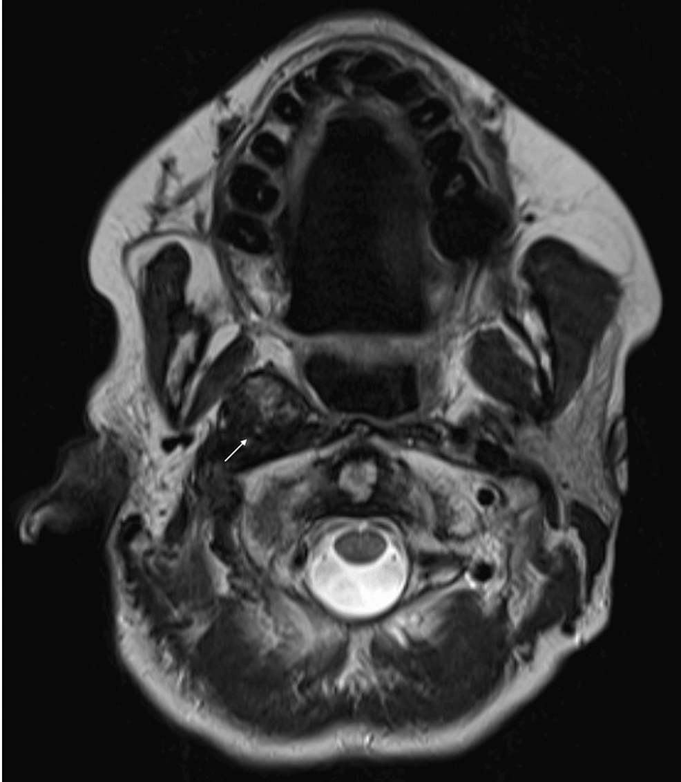 treatment-of-a-non-syndromic-carotid-body-paraganglioma-using-fast