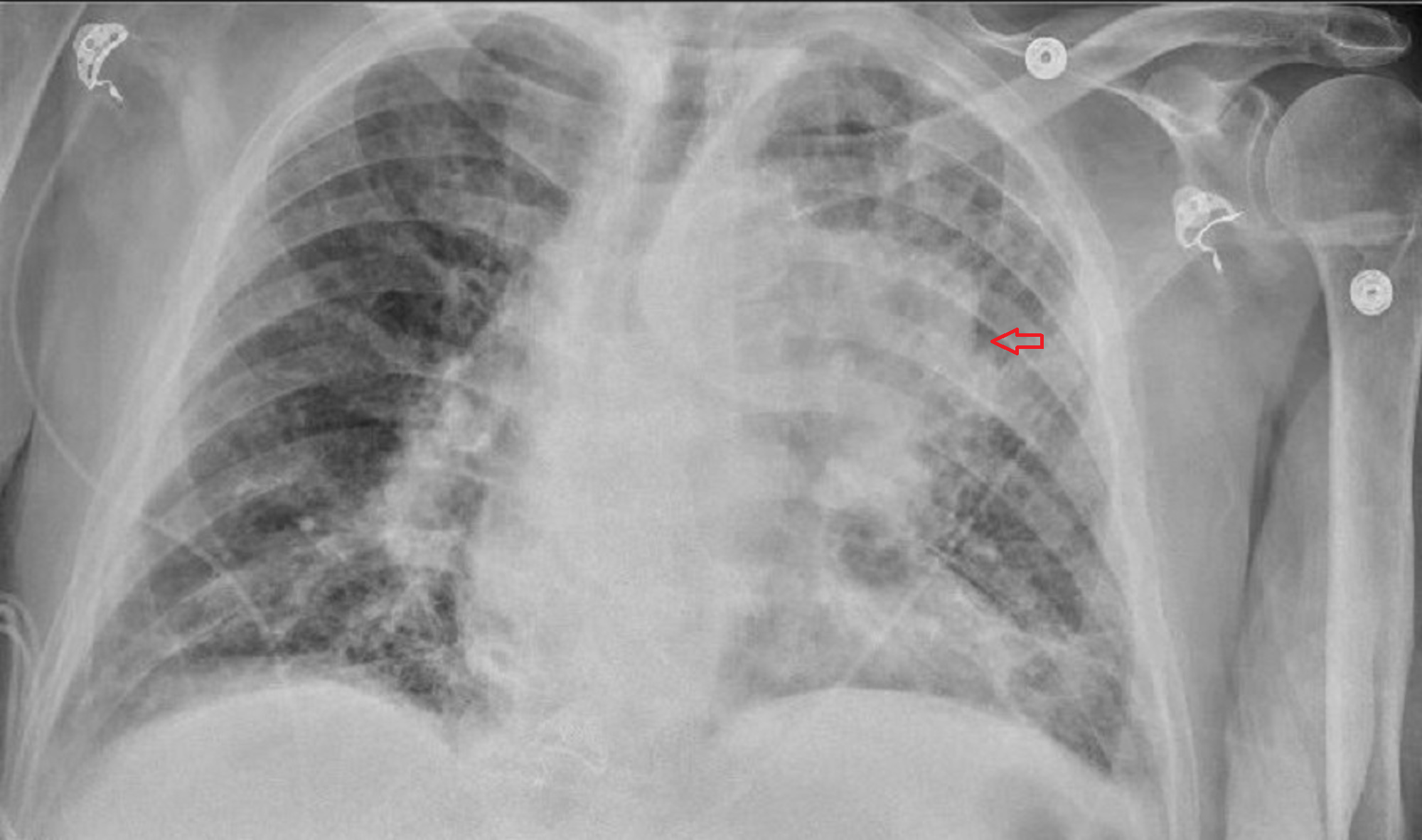 Chest X Ray Lung Cancer Stage