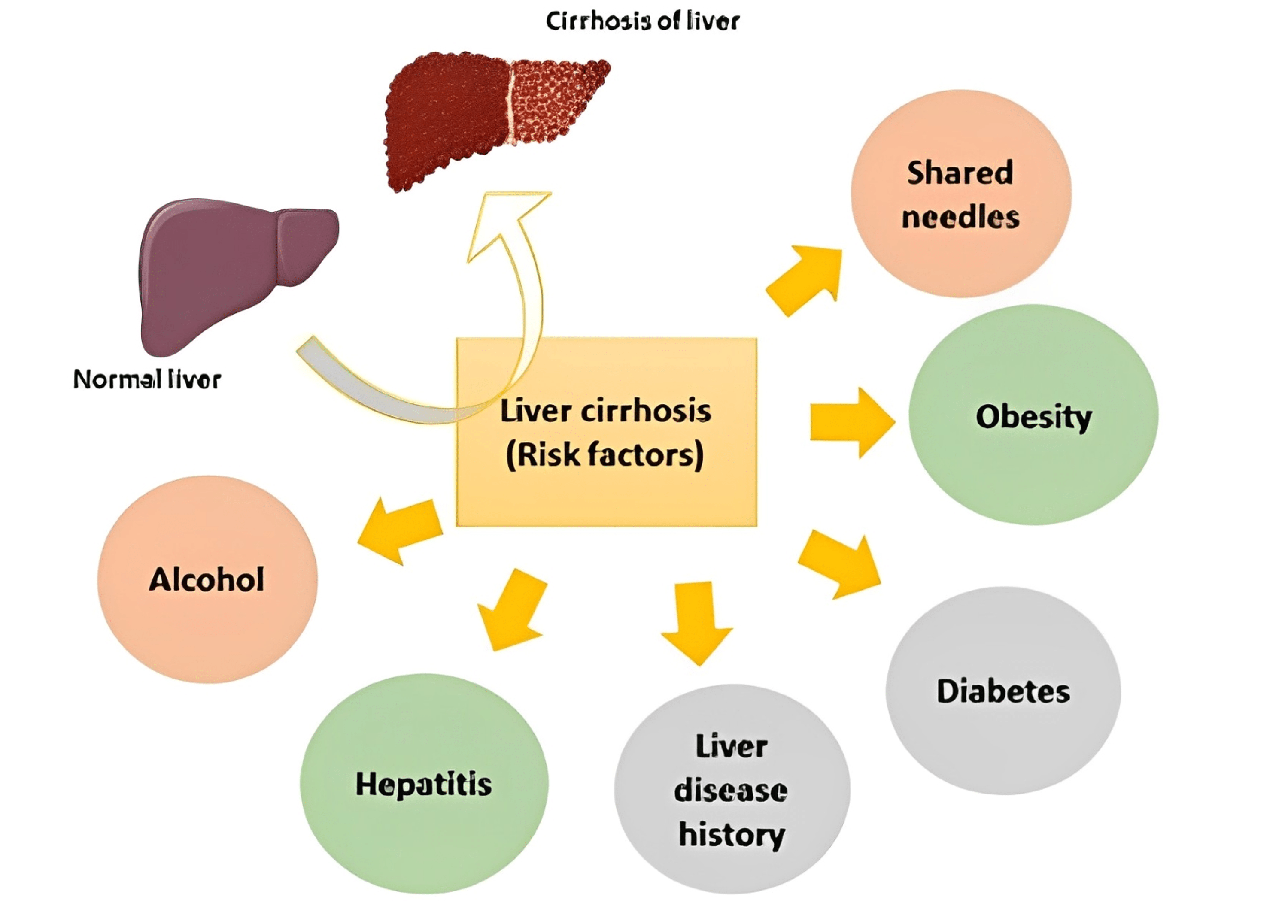 hematological-abnormalities-in-cirrhosis-a-narrative-review-cureus