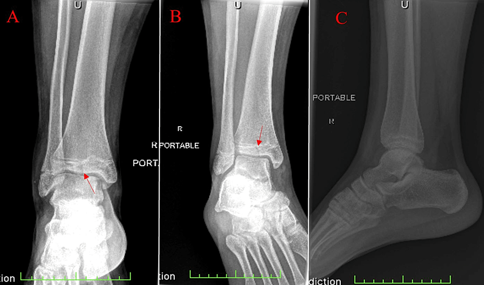 Foot X-ray of a 10 year-old male patient (white arrow indicates fracture).