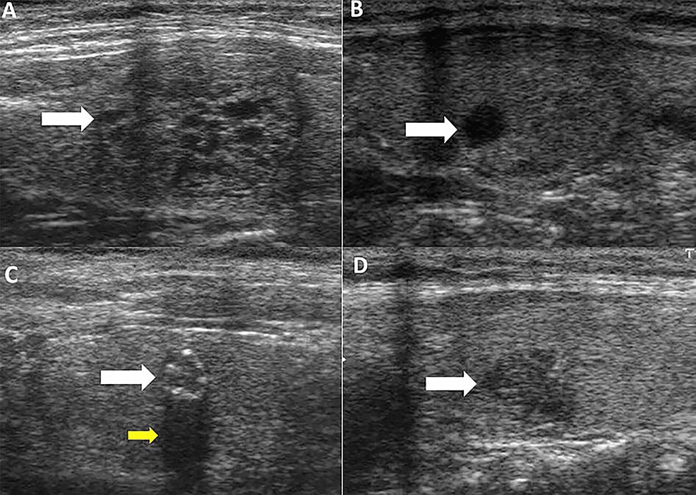 Cureus, B-mode Ultrasound Characteristics of Thyroid Nodules With  High-Benign Probability and Nodules With Risk of Malignancy