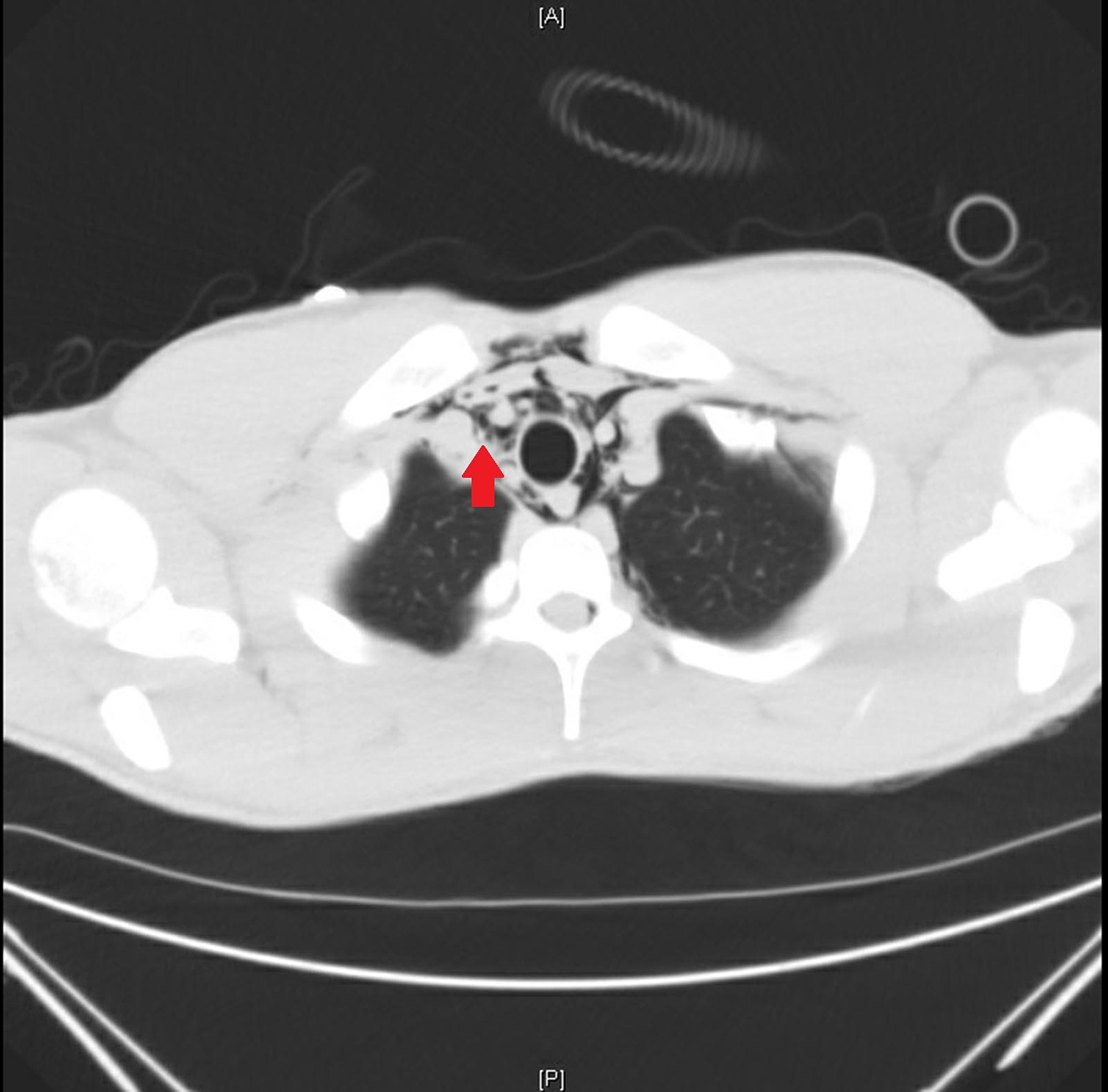 Cureus Silent Breathlessness A Case And Brief Review Of Spontaneous