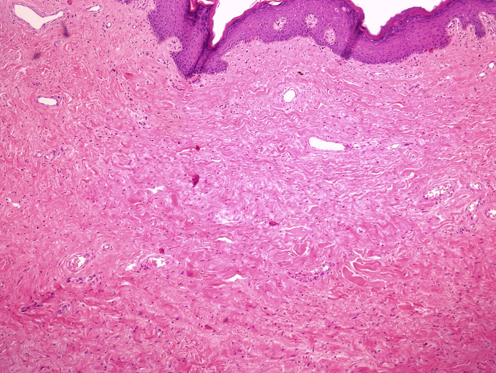Cureus Giant Ulcerated Fibroepithelial Stromal Polyp Of The Vulva A