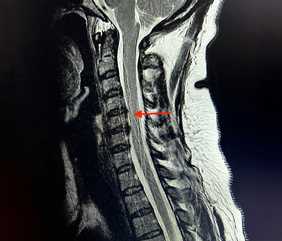 Sporadic Hemiplegic Migraine Cureus