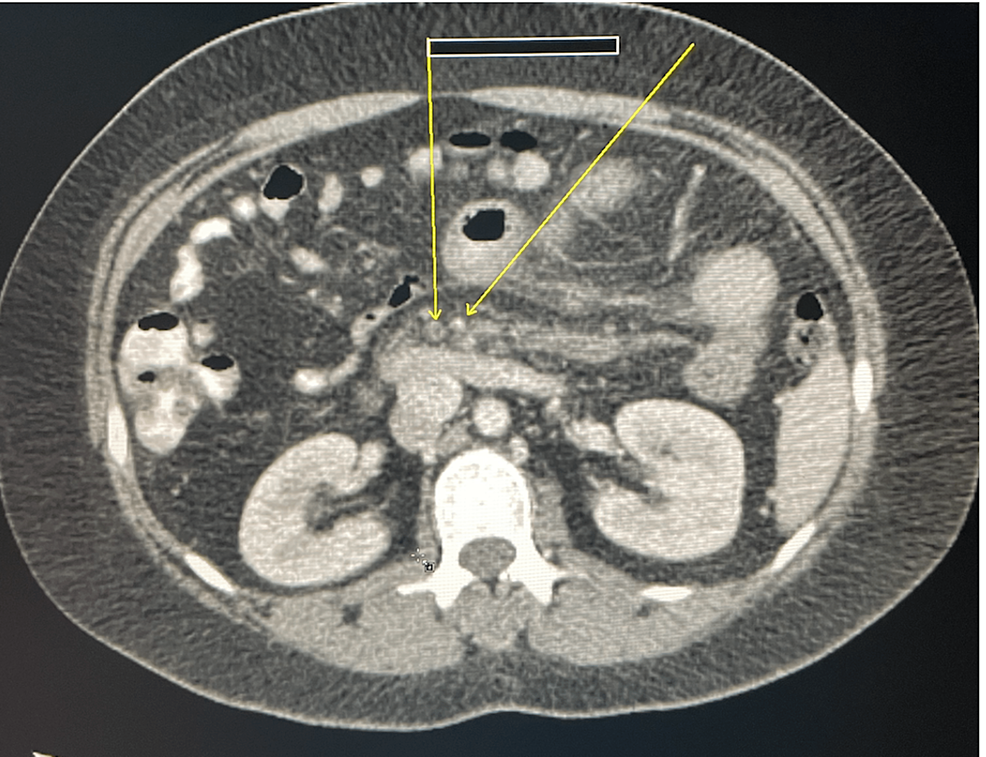 Cureus Acute Portal Vein Thrombosis as an Initial Presentation of