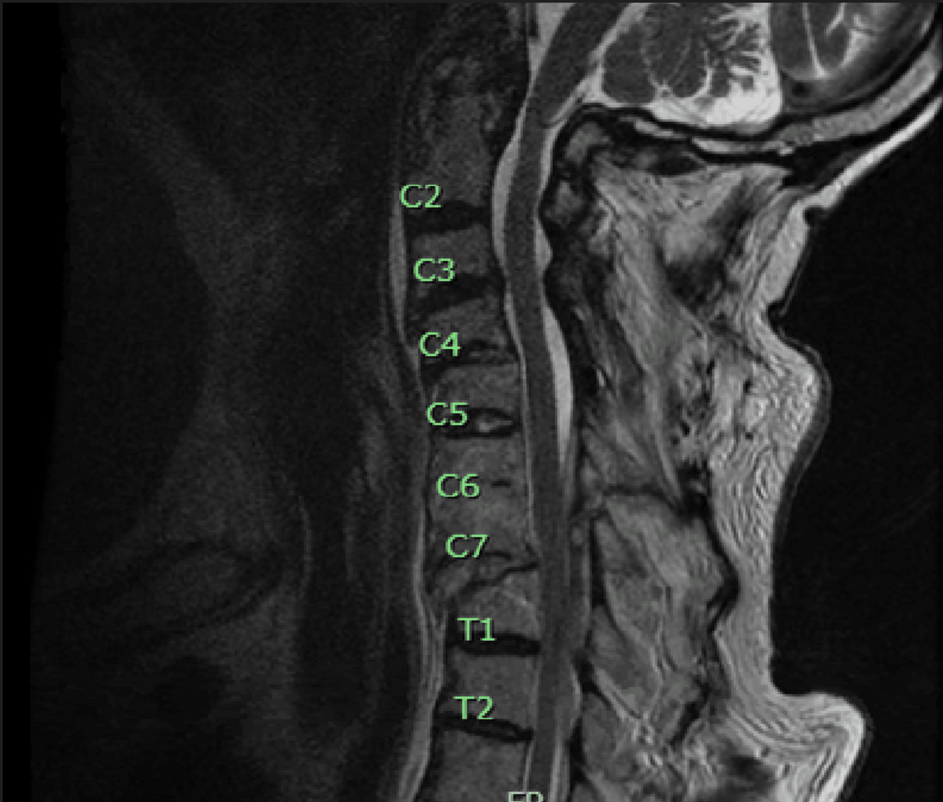 Cureus | Delayed Bilateral Vocal Cord Paralysis Following Cervical ...